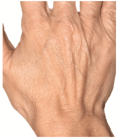 Ageing Hands hand rejuvenation
