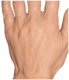 Ageing Hands hand rejuvenation