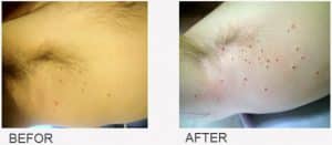 Before & After Treatment for Skin Lesions