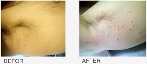 Before and After Skin Tag Removal