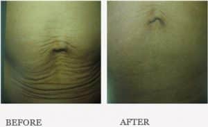 Before & After Mummy Tummy Package