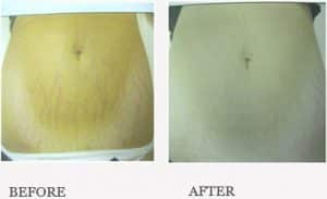 Before & After Mummy Tummy Package Treatment for Stretch Marks