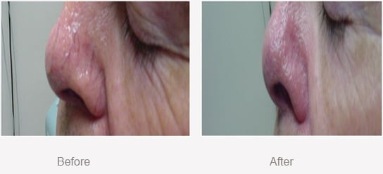 Before and After Thread Veins in Nose