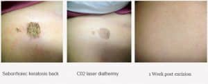 Co2 Laser Treatment for Keratosis