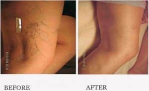Before & After Mummy Tummy Package Treatment for Thread Veins