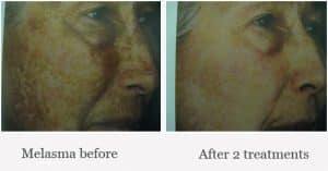 Before & After 2 Melasma Treatments