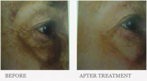 Before & After Dark Circle Treatment