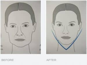 Asian Skin Treatment for V Shaped Face