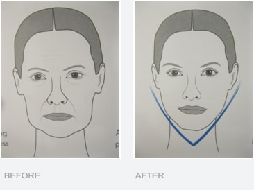 Before and After Jaw Line Slimming