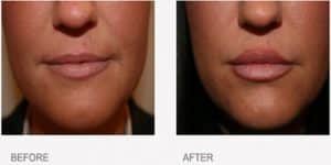 Before & After Lip Treatment
