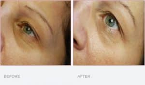 Carboxytherapy Treatment Around the Eyes