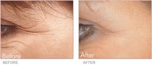 Before & After Injectable Filler for Crows Feet