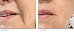 Before & After Injectable Filler Treatments