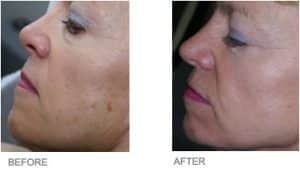 Side View of Before & After Laser Pigmentation Removal Treatment