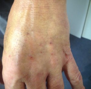 injectable fillers for ageing hands - after