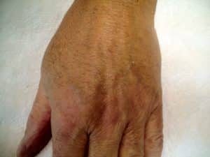 injectable fillers for ageing hands - before