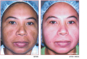 Before & 4 Weeks After Chemical Peel Treatment