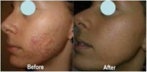 Before and After Chemical Peels