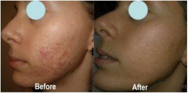 Before and After Glycolic Peels