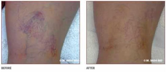 Before and After Thread Veins in Legs