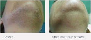 Before & After Laser Hair Removal for Polycystic Ovarian Syndrome