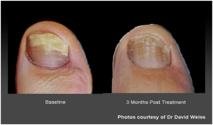 3 Months After Fungal Nail Treatment