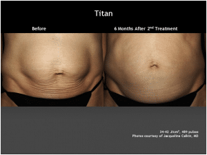 6 Month Results After Titan Laser Treatment