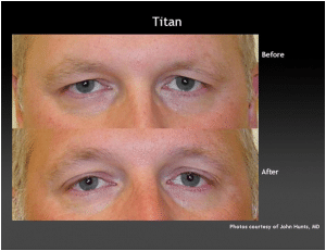 Before & After Eye Treatment Using Titan Laser
