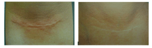 Before & After Acne Scarring Treatment
