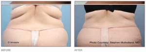 BodyTite Liposuction Results