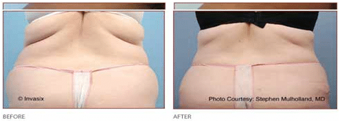 Before and After Fat Removal Flanks, Hips and Thighs