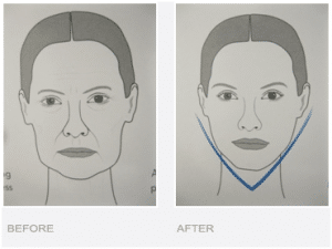V Shape Jaw Treatment for Asian Skin