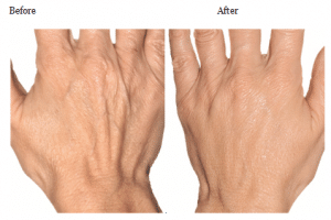 Before & After Ageing Hand Treatments
