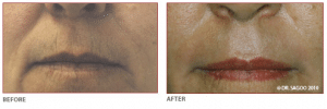 Before & After Laser Resurfacing Treatment