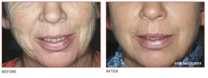 Results of Laser Resurfacing Treatment