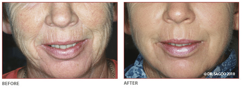 co2 laser resurfacing before and after treatment