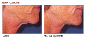 2 Treatment Results on Non-Surgical Laser Skin Tightening
