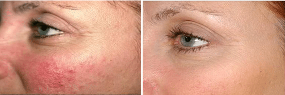 Before & After Laser Photorejuvenation Treatment