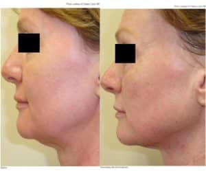 Before & After neckTite Liposuction Treatment