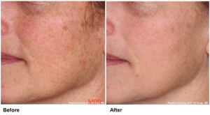 Before & After Pearl Laser Treatment
