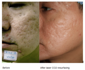 Laser Co2 Resurfacing to Treat Scarring Skin Rejuvenation