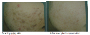 Before & After Photo Rejuvenation Treatment for Asian Skin