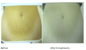 Results of 6 Stretch Mark Reduction Treatments