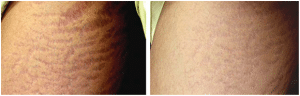 Before & After Stretch Mark Treatment