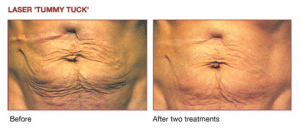 Results After 2 Tummy Tuck Treatments