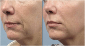 Before & After Fractora Treatment