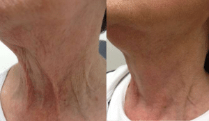 Before & After Fractora Treatment on the Neck