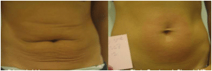 Before & After Fractora Treatment on Stomach