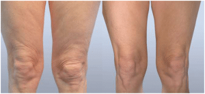 Fractora Treating Sagging Skin on Legs