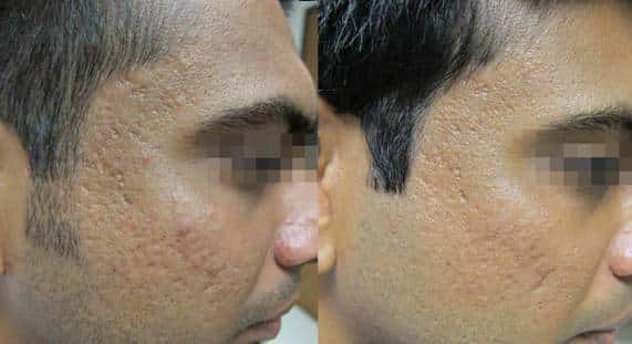 ACNE SCARRING treatment with fractora